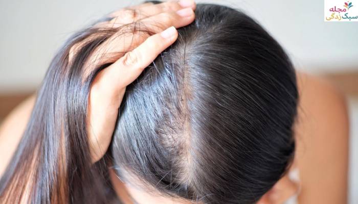 علت خارش سر و ریزش مو در زنان