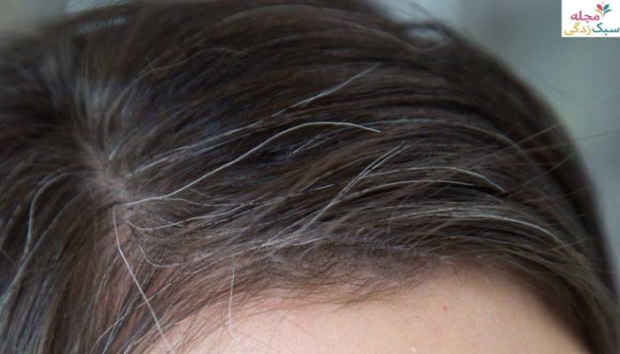 علت سفید شدن مو در جوانی