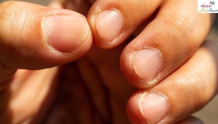 عوارض اشعه کاشت ناخن