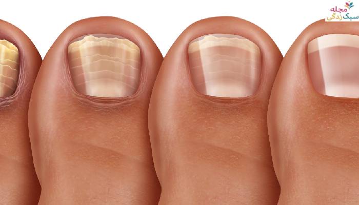 عوارض کاشت ناخن پا