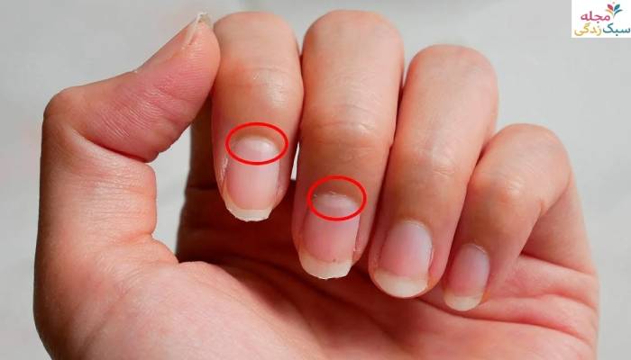 نشانه های ناخن ناسالم
