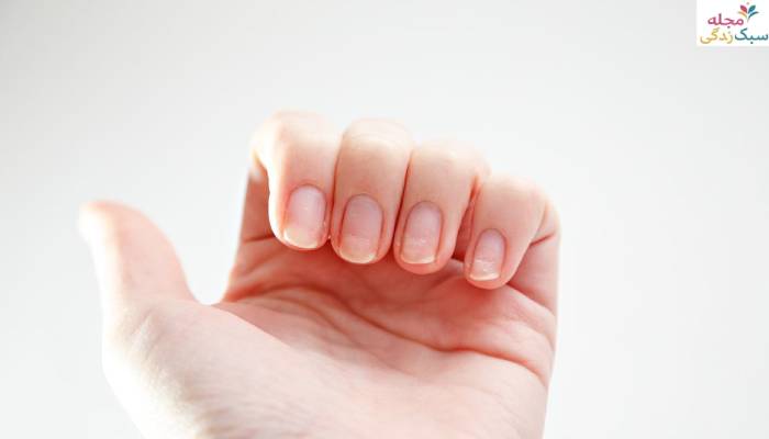 علت شکستن ناخن کمبود کدام ویتامین است